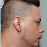 Otoplasty Before & After Patient #343