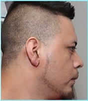 Otoplasty Before & After Patient #343