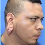 Otoplasty Before & After Patient #343