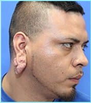 Otoplasty Before & After Patient #343