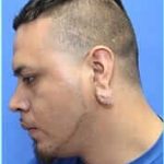 Otoplasty Before & After Patient #343