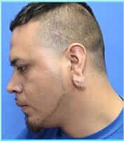 Otoplasty Before & After Patient #343