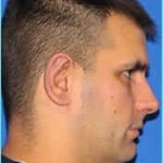 Otoplasty Before & After Patient #338