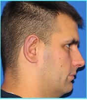 Otoplasty Before & After Patient #338