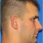 Otoplasty Before & After Patient #338
