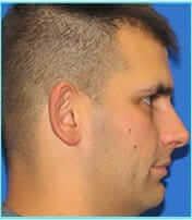 Otoplasty Before & After Patient #338