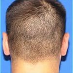 Otoplasty Before & After Patient #338