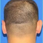 Otoplasty Before & After Patient #338