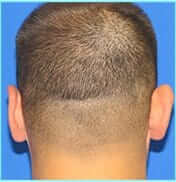 Otoplasty Before & After Patient #338