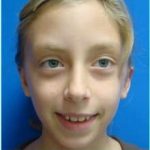 Otoplasty Before & After Patient #346