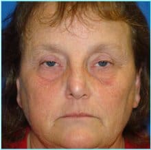 Nose Reconstruction Before & After Patient #616