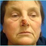 Nose Reconstruction Before & After Patient #616