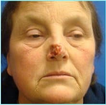 Nose Reconstruction Before & After Patient #616
