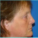 Nose Reconstruction Before & After Patient #616