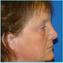 Nose Reconstruction Before & After Patient #616