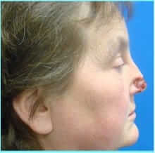Nose Reconstruction Before & After Patient #616