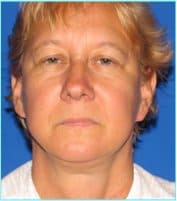 Facelift Before & After Patient #869
