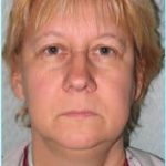Facelift Before & After Patient #869