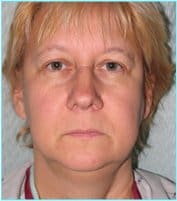 Facelift Before & After Patient #869