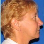Facelift Before & After Patient #869