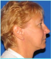 Facelift Before & After Patient #869
