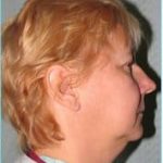 Facelift Before & After Patient #869
