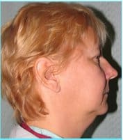 Facelift Before & After Patient #869