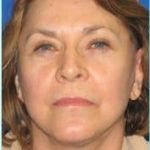 Facelift Before & After Patient #898