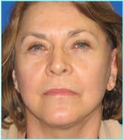 Facelift Before & After Patient #898