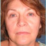 Facelift Before & After Patient #898