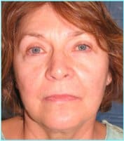 Facelift Before & After Patient #898