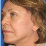 Facelift Before & After Patient #898