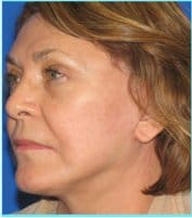Facelift Before & After Patient #898