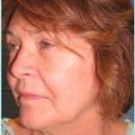 Facelift Before & After Patient #898
