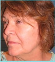 Facelift Before & After Patient #898