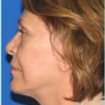 Facelift Before & After Patient #898