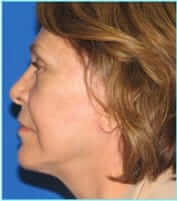 Facelift Before & After Patient #898