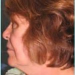 Facelift Before & After Patient #898