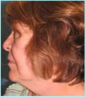 Facelift Before & After Patient #898