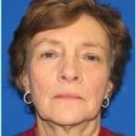 Facelift Before & After Patient #954