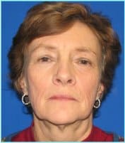 Facelift Before & After Patient #954