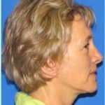 Facelift Before & After Patient #954