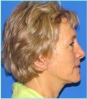 Facelift Before & After Patient #954
