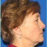 Facelift Before & After Patient #954