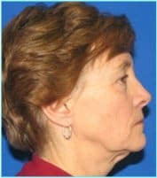 Facelift Before & After Patient #954
