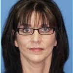 Facelift Before & After Patient #928