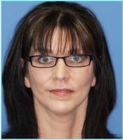 Facelift Before & After Patient #928