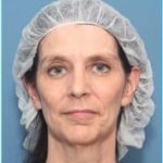Facelift Before & After Patient #928