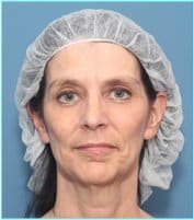 Facelift Before & After Patient #928