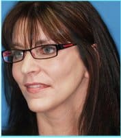 Facelift Before & After Patient #928